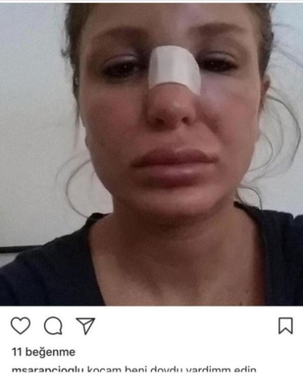 Berk Oktay'ın eşi Merve Şarapçıoğlu'dan şok dayak iddiası! - Resim : 1