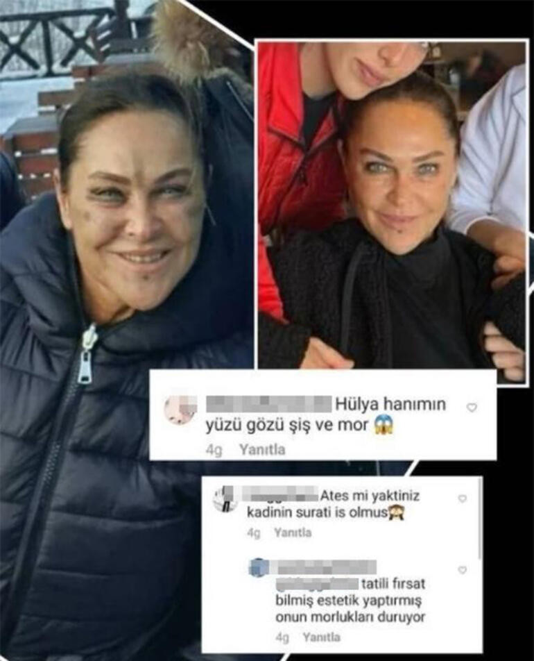 Hülya Avşar'ın yüzündeki morlukların sebebi belli oldu - Resim : 1