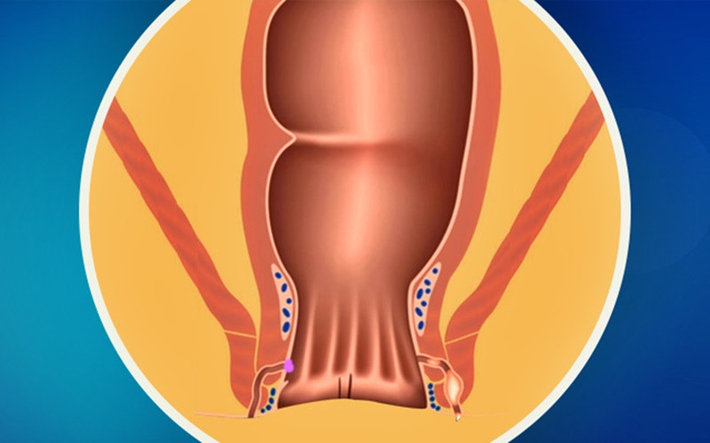 Fistül nedir? Belirtileri nelerdir? Tedavisi nasıl yapılır? - Resim : 1