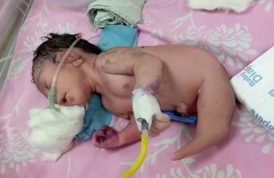 Doktorlar ayak yerine boynuzla doğan bebeği görünce şaşkına döndü - Resim : 1